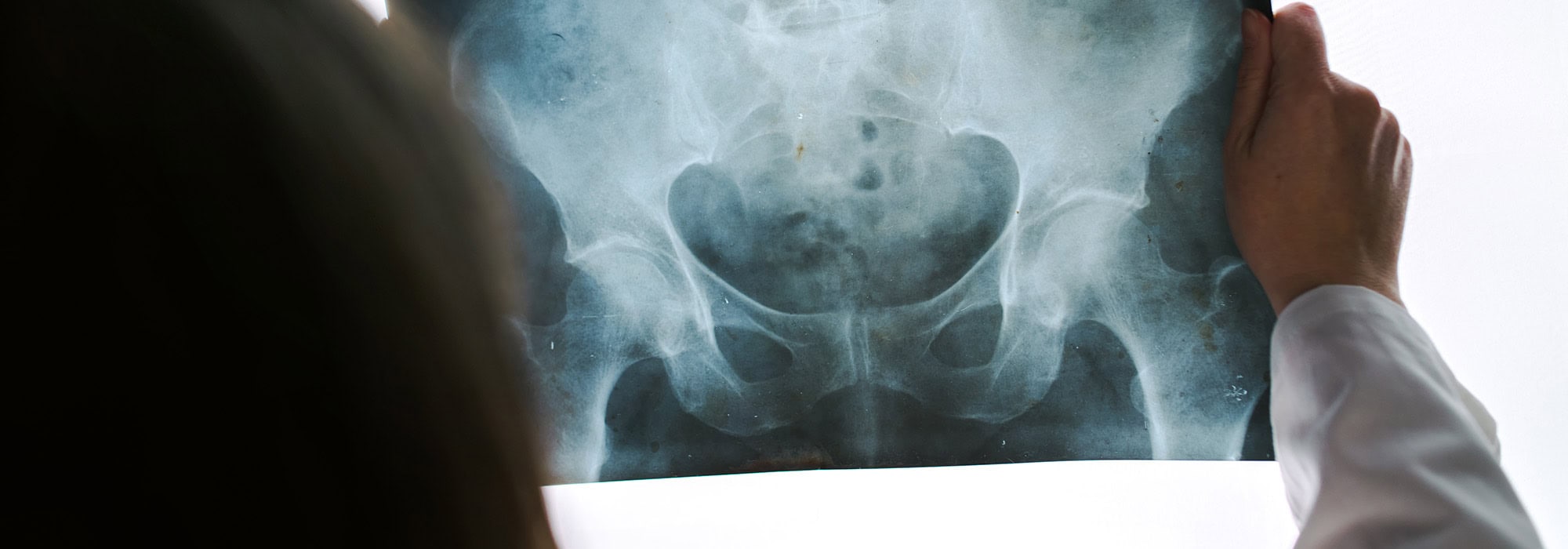 Doctor reviewing hip x ray