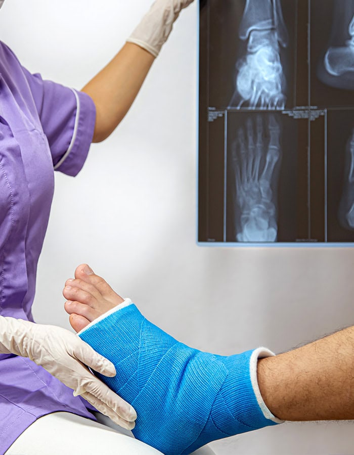 Broken foot and x ray